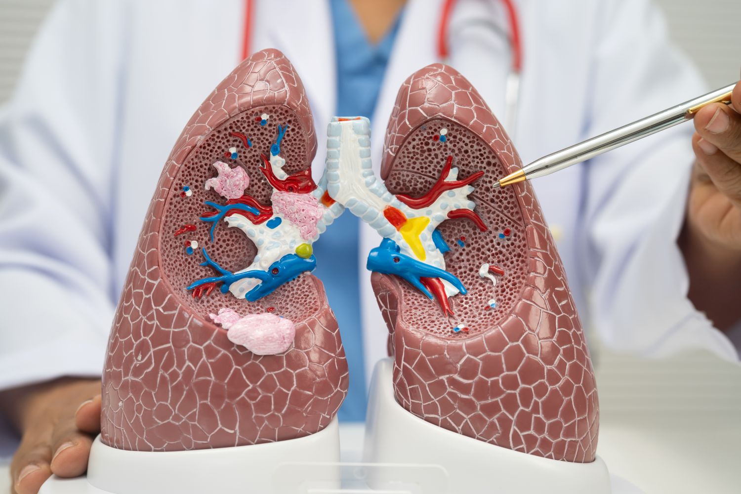 Lung cancer