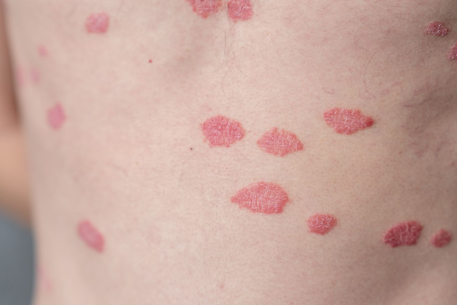 Red spots appearing on the body.